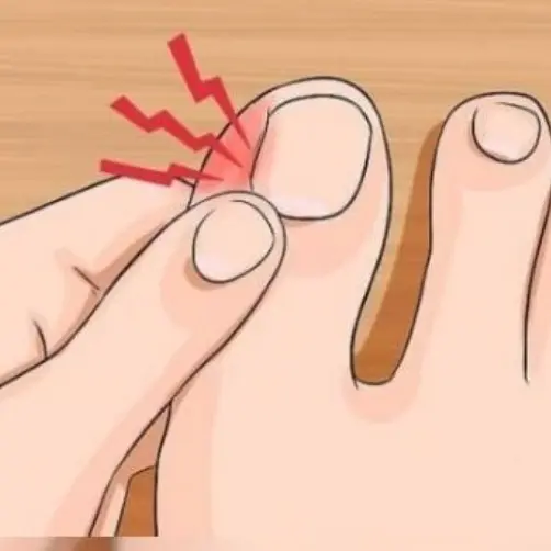 What should I do about ingrown toenails?